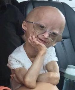progeria kids