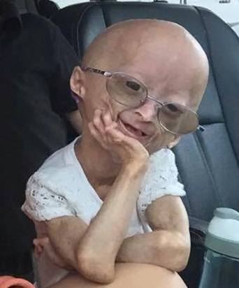 progeria facts