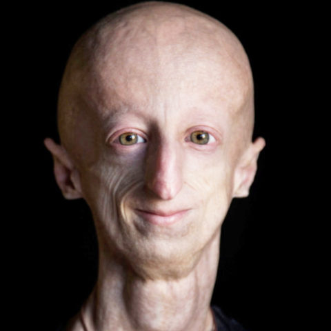 Quick Facts | The Progeria Research Foundation